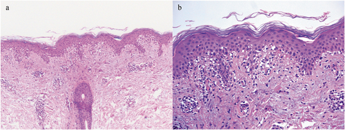 Figure A3. A Lichenoid-like changes with superficial perivascular T-cell infiltrate (hematoxylin-eosin stain, 10X magnification); B marked spongiosis, lymphocytic infiltrate at the papillary dermis with eosinophils and epidermal orthokeratosis (hematoxylin-eosin stain, 20X magnification).