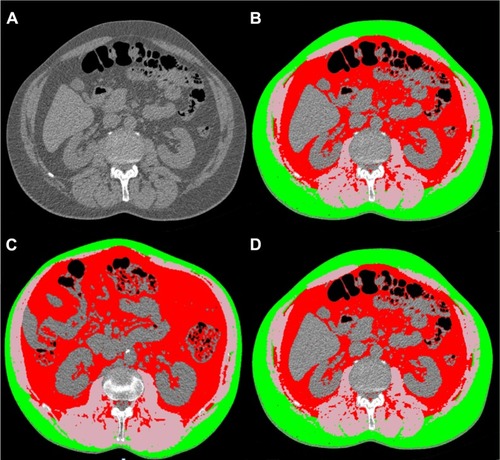 Figure 1 Body composition analysis and differences in fat distribution.