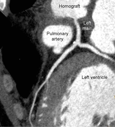 Figure 3 Late postoperative chest computed tomography revealed a patent left coronary artery after homograft root replacement.