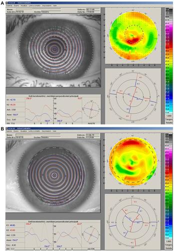 Figure 3 Right eye videokeratographic maps of a 41 yrs old female patient, before (A) and after (B) enhancement 2 years post-PRK using topographically guided customized excimer laser photoablation. After PRK her DCVA was 20/22 with −1.50sph=−1.50cyl (130°). Fifteen years after enhancement using topographically guided excimer laser photoablation with Corneal Interactive Programmed Topical Ablation platform (CIPTA, LIGI, Taranto, Italy) her DCVA was 20/20. The topographic values highlight the improved corneal profile obtained.