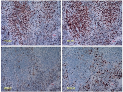 Figure 1 Immunohistochemistry of the MMR proteins. The tumor cells were assessed for expression of PMS2 (+), MLH1 (+), MSH2 (−), and MSH6 (−).Abbreviation: MMR, mismatch repair.