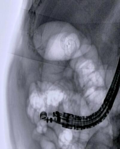 Figure 5 Fluoroscopic view of newly positioned electrocautery lumen-apposing metal stent (EC-LAMS) into the gallbladder lumen.