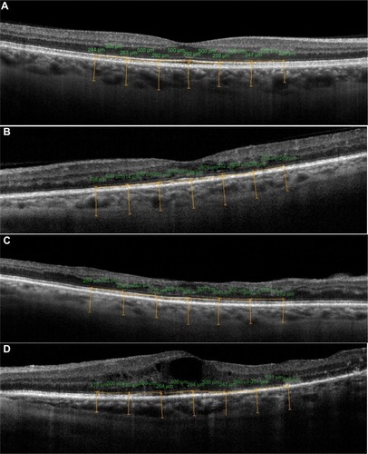 Figure 2 Representative images of (A) the eye of the control patient; (B) the eye of a patient with mild nonproliferative diabetic retinopathy; (C) a patient with moderate nonproliferative diabetic retinopathy and diabetic macular edema; and (D) a patient with treated proliferative diabetic retinopathy – note that in this patient there is a disruption in the photoreceptor inner/outer segment junction, probably because of the retinal ischemia.