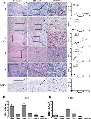 Figure 1. slanMo and NK cells infiltrate human melanoma. (A) slanMo (slan – green) and NK cells (CD56 – red) were analyzed in FFPE samples of melanoma patients from stage I, stage II, stage III cutaneous lesions (III cutan.), stage III Lymphnode (III LN) metastasis, stage IV distant metastasis, and healthy skin (hSkin) (n = 7). Based on 3 images (200x magnification) of double-stained (slan + CD56) samples, the density of cells/mm2 was analyzed and densities of slanMo were correlated with CD56+ NK cells. Density of (B) slanMo (slan) and (C) CD56+ NK cells displayed as cells/mm2 over all stages of melanoma development and in healthy skin. Number of patients for stage I (n = 10), stage II (n = 16), stage III (n = 10), stage III LN (n = 10), stage IV (n = 8), and healthy skin (n = 7). Original magnification x100 (left column), x200 (middle column), x630 (right column).