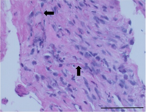 Figure 2. Photomicrograph of a section from a biopsy of the L3/L4 intervertebral disc of a dog, demonstrating branching fungal hyphae within the centre (arrows) (periodic acid-Schiff; bar = 100 µm).