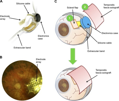 Figure 1 (A) Structure of the Argus II Retinal Prosthesis System showing the electrode array, its silicone cable connected to the extraocular electronics case, and the band used for extrascleral fixation. (B) Fundus photograph showing the position of the electrode array over the macula in a patient with retinitis pigmentosa. (C) Schematic adapted technique for retinal prosthesis implantation with a scleral flap at the sclerotomy site (1) and an autograft of superior temporalis fascia (2). Before closure of Tenon’s capsule and conjunctiva, the temporalis fascia covers both the scleral flap and the extraocular electronics case.