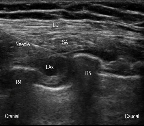 Figure 2 Ultrasonogram of serratus anterior plane block.Abbreviations: LD, latissimus dorsi muscle; SA, serratus anterior; LAs, local anesthetics; R4, the fourth rib; R5, the fifth rib.