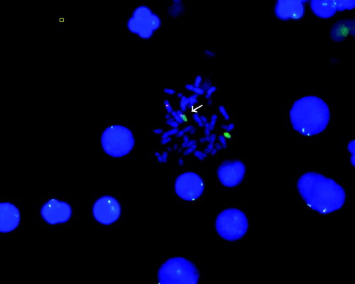 Figure 2.  FISH analysis of the patient showing t(X;15). FISH analysis was performed on metaphase spreads of the patient. Red signals show chromosome X centromere and green signals show chromosome 15. Normal X chromosome (red) and chromosome 15 (green) are evident. The arrow indicates derivative (X) chromosome.