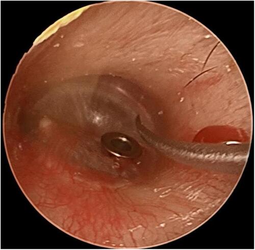 Figure 1 Anterior inferior quadrant of tympanic membrane.