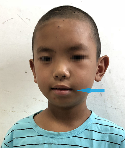 Figure 3 After facial paralysis treatment (The arrow shows a marked improvement symptoms of crooked mouth after treatment).
