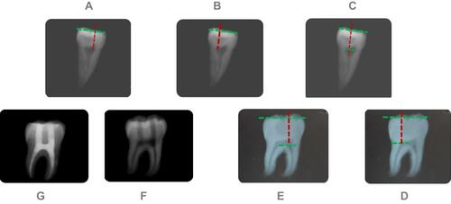 Figure 2 Determining the location and path of accessing the root canals through a TREC on the mesial and distal (A–C) and buccal and lingual (D and E) radiographs. The distance between the buccal and lingual surfaces of the teeth and also the distance between the mesial and distal surfaces of the teeth were determined (green and red dotted lines) and the perpendicular path to the occlusal surface was estimated to access the mesial and distal canal orifices such that the enamel-dentin bridge between the two access cavities was preserved. F shows the TREC access cavity and G shows the obturated canal along with a restored access cavity.