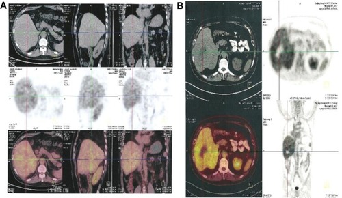 Figure 7 Comparison of PET/CT before and after therapy.