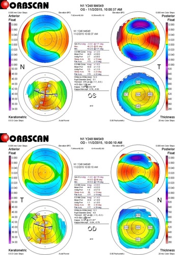 Figure 1 Pre-op Orbscan of the left and right eyes showing early ectasia.