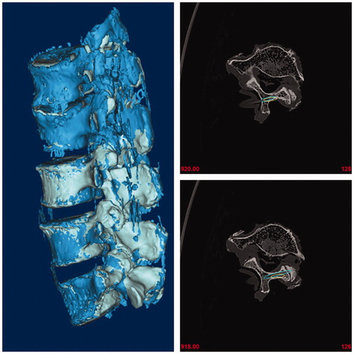 Figure 4. Post-operative and pre-operative 3D lumbar models with actual and planed trajectories were coincided in the same coordinate system.