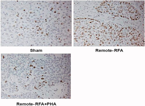 Figure 4. PHA reduces cell proliferation following RFA. Immunohistochemical staining for ki-67 demonstrating cell proliferation. Tumor RFA increases nuclear staining, with PHA treatment reducing cell proliferation to sham level 7 days post RFA.
