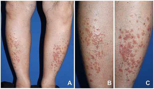 Figure 1 Clinical manifestations: (A) multiple discrete indurated erythematous-to-brownish papules, some coalescing into plaques on the pretibial skin and multiple varicose veins; close-up pictures of the right (B) and the left legs (C).