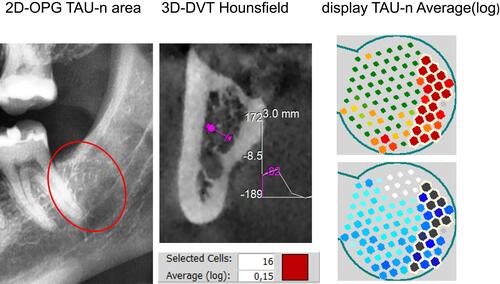 Figure 3 The top right picture shows a clear division into two parts: The right part, which points distally when the TAU sensor is inserted, corresponds with the strong red coloration to a high attenuation and thus reduced bone density with possible osteolysis. The clear distinction from red to green shows that the distal root of tooth 37 was detected in the mesial part of the sensor. In TAU-n, hard substance with low attenuation is marked with green or light-blue to white. The sensor fields marked white-blue to black in the lower right image allow an even more detailed interpretation of the attenuation. Both TAU-n measurement images correspond with the HU value of −8.5 in the edentulous are of 38 shown in the center part of Figure 3.