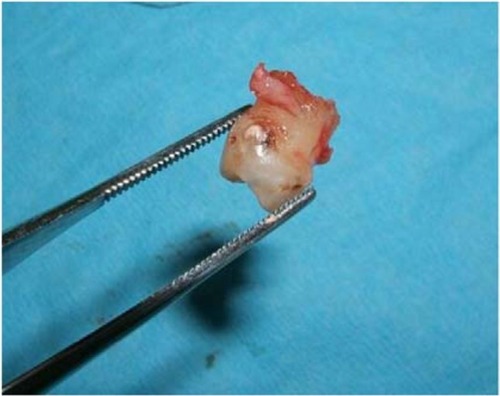 Figure 4 The unrestorable carious and exfoliating mandibular second deciduous molar was extracted.