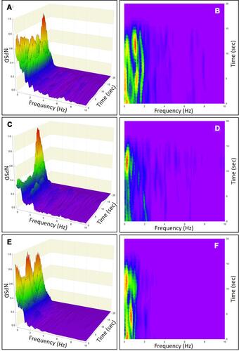 Figure 11 Normalized ensemble eyes-open (Eo) medial-lateral (ML) time-resolved phybrata power spectral density (NPSD) plots (left) and spectrograms (right) for (A and B) baseline testing of 5 healthy patients; (C and D) post-concussion testing of 5 patients with vestibular impairment; (E and F) post-concussion testing of 5 patients with neurological impairment.