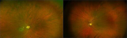 Figure 1 Widefield imaging showing classical features of CRAO: pale retina with a cherry-red spot in the right eye.