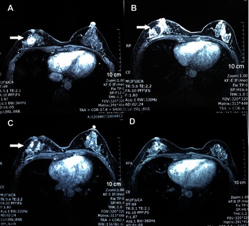 Figure 2 Contrast enhanced magnetic resonance imaging of the breast. (A) Before treatment, a well-defined mass (arrow) was observed at the rear of right breast nipple which showed homogeneous strengthening on enhanced magnetic resonance imaging. (B) Five days after the first high intensity focused ultrasound HIFU ablation, a non-contrast enhancement region (arrow) showed up in the previous mass area. (C) Five days after the second treatment, the non-contrast enhancement region was enlarged with irregular boundary and garland-like peripheral enhancement (arrow). (D) Three months after the last treatment, the mass was well ablated and only demonstrated a patchy, heterogeneous architectural distortion region. The nipple retraction was improved.