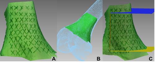 Figure 4 (A) An image of scanned surface with the patterned light, marked with “X”. (B) The scanned surface is registered to the CT-scan model by a surface matching algorithm. (C) After the registration is done, the three preoperatively resection planes were superimposed onto the extracted bone surface, in reference to the “X” marks, to serve as a visual aid for the surgeon to accurately reproduce and draw the preoperative plan.