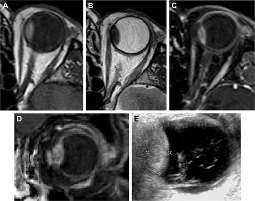 Figure 7 Choroidal melanoma on MRI and ultrasound scan.