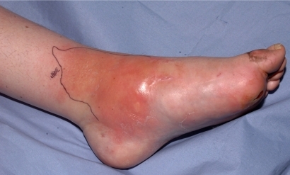 Figure 2 Spreading cellulitis.