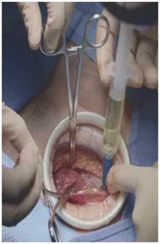 Figure 1. Application of HTX-011 during open herniorrhaphy.HTX-011 is applied without a needle into the surgical site following final irrigation and suctioning, and prior to suturing of each layer.
