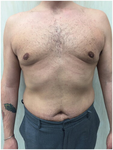Figure 4. Postoperative photo at 2 months after surgery.