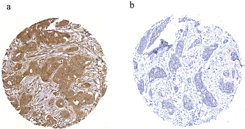 Figure 1. SLC7A11 protein expression in representative invasive breast cancer tissue microarray cores determined using immunohistochemistry showing a) high, and b) negative expression. Magnification x20.