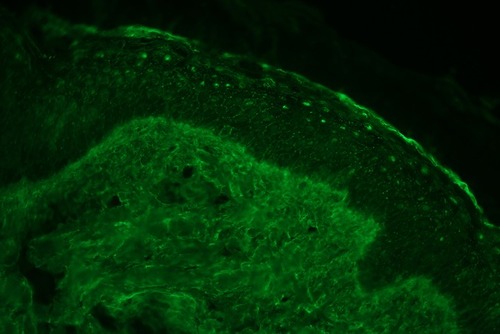 Figure 3 Direct immunofluorescence shows epidermal nuclear staining of immunoglobulin G (400x).