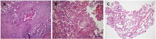 Figure 2 A foreign body tissue reaction against germinative membrane of probable hydatid cyst on histological examination of an excisional biopsy.Notes: (A) There is a dense inflammatory reaction composed of lymphocytes, plasma cells, and histiocytes in the lung parenchyma surrounding the lesion (100× H&E). (B) In another area of the same slide, there are Masson bodies filling the airspaces (100× H&E). (C) Bronchoscopic biopsy sample containing many Masson bodies (100× H&E).