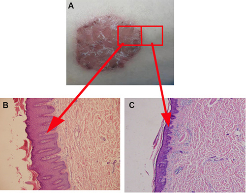 Figure 1 Psoriatic skin differs from adjacent skin in both appearance and histopathology. (A) The appearance of psoriasis patient; (B) Histopathology of psoriasis skin; (C) Histopathology of adjacent normal skin in psoriasis patient.