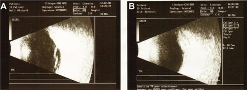 Figure 3 Case 1. B-scan ultrasonography. Thickening of the ocular coats associated with subretinal fluid adjacent to the mass (A). There is no orbital shadowing. Mass was prominent in the vitreous cavity and measured 11 mm × 4.6 mm (B).