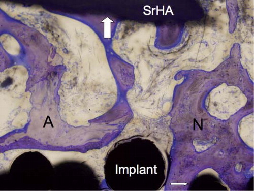 Figure 5. The implant-bone interface showing gap healing and ongrowth of bone onto the implant and SrHA. New bone (N), preserved allograft (A), ongrowth onto the implant (thin arrow), and ongrowth onto the SrHA (thick arrow). 10× objective.