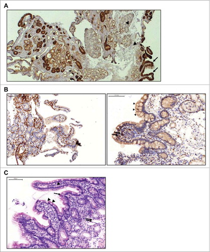 Figure 2. Immunohistochemical evaluation of duodenal biopsy tissue from a patient with lung adenocarcinoma treated with solitomab (3 µg/day for 8 days, 12 µg/day for 3 days). A, IHC staining of EpCAM expression shows EpCAM-positive epithelial cells in duodenal crypts and along villis (arrows) and EpCAM-negative cells of the mucosa and Brunner's cells (arrow heads). B, Infiltration of duodenal epithelium by CD3-positive (left) and T-cell restricted intracellular antigen (TIA)-positive (right; arrows) lymphocytes. Vacuolated tip enterocytes (arrow heads) are also present. C, HE staining showing damage to the crypt structure with villus collapse (arrow) and mucosal ulceration (double arrow). Vacuolated tip enterocytes (arrow heads) are visible along the villi.