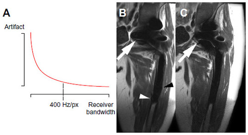 Figure 5 Graph demonstrating how misregistration artifacts can be reduced in the frequency-encoding directions by increasing the receiver bandwidth (A), although this effect plateaus at about 400 Hz/pixel on a 1.5 T system. At 256 Hz/pixel (B), there is the typical susceptibility artifact around the spherical component of a total hip replacement comprising signal loss, pile-up, and geometric distortion (arrow), which is reduced when the receiver bandwidth is increased to 480 Hz/pixel (C) but is accompanied by an increase in noise. The longitudinally oriented femoral stem (arrowheads) produces much less artifact.