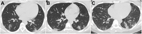 Figure 1 Chest CT images of three pregnant women with COVID-19 pneumonia. (A) 28-year-old female with 34 weeks plus 5 days of gestation, presenting fever for 4 days. CT demonstrated scattered pure consolidation in both lungs with predominantly peripheral distribution. (B) 30-year-old female with 31 weeks of gestation, presenting fever for 2 days. Scattered pure consolidation lesions in both lungs with peripheral distribution were detected. (C) 28-year-old female with 24 weeks pregnancy, presenting fever for 2 days. Scattered ground-glass opacity (GGO) with consolidation and pure consolidation lesions in both lungs with peripheral distribution were demonstrated.