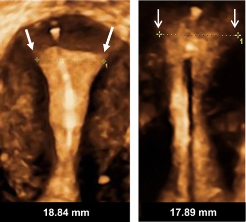 Figure 8 Frameless copper and drug delivery systems occupy limited space in the uterine cavity and have no transverse arms, eliminating embedment and secondary perforation of the uterine wall.