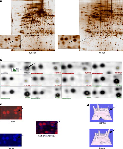 Figure 2.  (a) Two representative 2-DE gels, pH 4-7 of a normal and a tumor sample. Close-up areas showing the Rho-GDI protein spot (arrow). (b). Representative PDQuest screenshot showing six segments of “normal gels” and five of “tumor gels”. The Rho-GDI spot is marked with a yellow square throughout all members. The master gel shows the corresponding histograms with the tumor sample marked in green and the normal sample marked in red. (c). Multi-channel view of the same gel-segments (Rho-GDI) visualizing the overexpressed protein in the tumor sample (blue) and the normal control (red). (d). 3-D rendered close-up segments confirming the Rho-GDI over expression in the tumor samples (arrows).