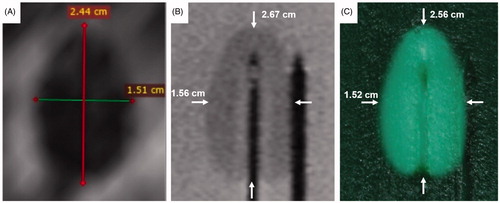 Figure 10. (A) Zone of coagulative necrosis in a patient as indicated by non-perfused tissue. The scan was acquired immediately after the patient received LITT for 3 min. at 13.75 W. Further information can be found in Natarajan et al. [Citation1]. (B) Phantom coagulation zone under T2-weighted MRI showing major and minor axes (white arrows). Note that the catheters in the center and on the right contain the laser fiber and thermal probe respectively. (C) Phantom coagulation zone under direct visualization showing major and minor axes (white arrows). Note the needle tracks in the center and to the right.