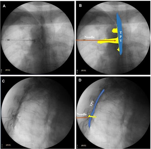 Figure 6 Delineation of the radiopaque agent in the TPV space under fluoroscopy. (A) The AP view on fluoroscopy showed that the TPV space was evenly delineated. The lateral boundary of the radiopaque agent was outside the lateral edge of the pedicle. (B) Schematic diagram of the delineation in the AP view of fluoroscopy. In blue, the TPV space. In yellow, the space of the thoracic nerve stained with opaque agent. (C) The lateral view of fluoroscopy showed that the TPV staining of the radiopaque agent was a rough arc outside the intervertebral foramen. (D) Schematic diagram of the delineation in lateral view of fluoroscopy. In blue, the TPV space. In yellow, the space of the thoracic nerve stained with opaque agent. In brown, the needle.