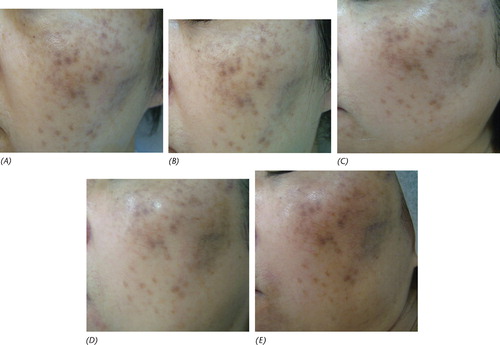 Figure 3 After the first(A), second (B), sixth (C), 10th (D) and 11th (E) laser sessions with iontophoresis vitamin C.