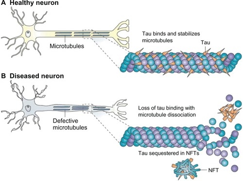 Figure 5 (A) Tau facilitates microtubule stabilization within cells and is particularly abundant in neurons. (B) it is thought that tau function is compromised in Alzheimer’s disease and other tauopathies.Notes: This probably results from both tau hyperphosphorylation, which reduces the binding of tau to microtubules, and the sequestration of hyperphosphorylated tau into neurofibrillary tangles (NFTs), which reduces the amount of tau that is available to bind microtubules. The loss of tau function leads to microtubule instability and reduced axonal transport, which could contribute to neuropathology. Copyright © 2009. Nature Publishing Group. Reproduced with permission from Brunden KR, Trojanowski JQ, Lee VM. Advances in tau-focused drug discovery for Alzheimer’s disease and related tauopathies. Nat Rev Drug Discov. 2009;8(10):783–793.Citation97