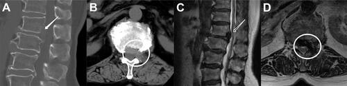 Figure 7 Postoperative CT and MRI images. Postoperative sagittal (A) and axial (B) views by computed tomography. Postoperative sagittal (C) and axial (D) views by magnetic resonance imaging. The position indicated by The white arrow and circle indicates that the vertebral margin to which the calcified lesion was attached was removed by casing rotation. The patient’s pain was improved after surgery compared with that before surgery, and the compression site obtained sufficient decompression.