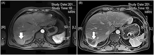 Figure 2. A 57-year-old male patient with CRLM. (A) CEMRI showed one lesion 14mm in diameter (thick arrow) with hyper-enhancement in the arterial phase. (B) Three months after ablation, the ablation area 43mm in diameter (thick arrow) showed that the ablated volume did not show contrast enhancement in the arterial phase.