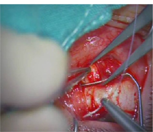 Figure 6 The muscle, as planned, was fixed to the sclera 3–6 mm from the insertion with sutures on both sides.