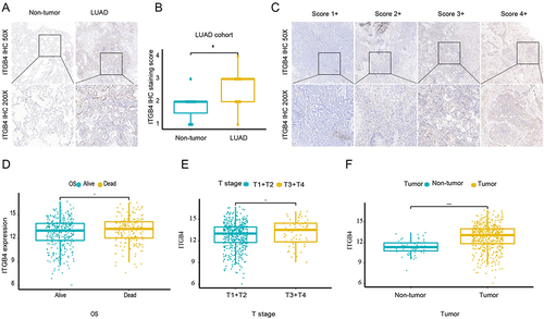 Figure 5 Immunohistochemical (IHC) analysis of components of the anoikis-related prognosis signature in LUAD and normal lung tissue. (A): Level of expression of ITGB4 in LUAD and adjacent normal lung tissue. (B): Statistical analysis of the differences in scores. (C): IHC images with different ratings. (D): Correlation between the expression of ITGB4 and overall survival. (E): Relationship between ITGB4 expression level and T stage. (F): Relationship between ITGB4 expression level and tumor stage. 1+ indicating no staining, 2+ indicating weak staining, 3+ indicating moderate staining, and 4+ indicating strong staining.*p<0.05, ****p<0.0001.