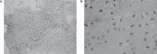Figure 4.  Photomicrographs of the tumor from the distal phalanx show chondroid matrix and no atypical tumor cells (A: ×100; B: ×200).